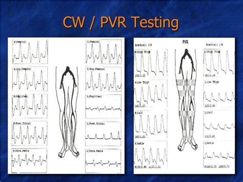 pvr test results